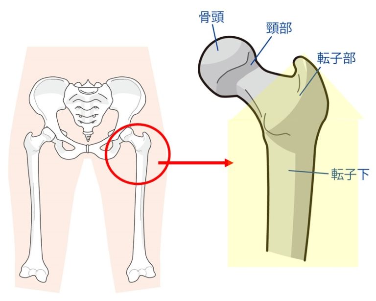 大腿骨骨折で認められる等級と認定のポイント